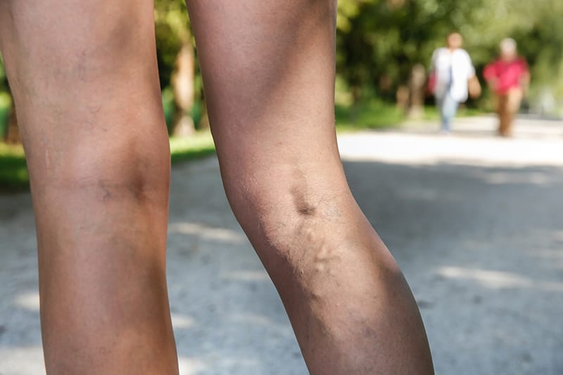 A pair of legs out for a walk, that have varicose veins